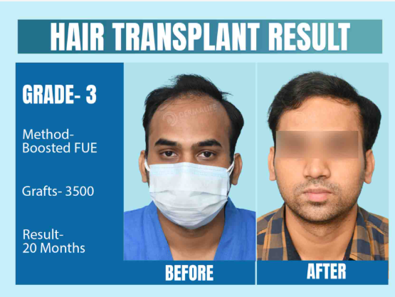 Do’s and Don’ts After a Hair Transplant in Delhi: Best Care Tips by Dr Gaurav Garg